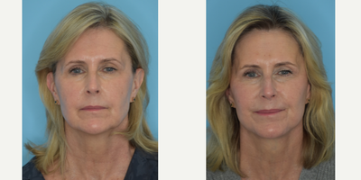 Buccal Fat Removal before and after photo