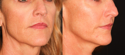 Dermal Fillers before and after photo