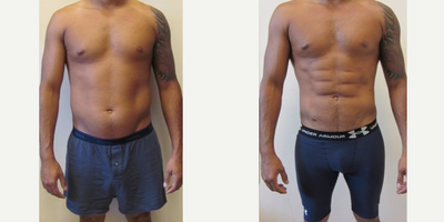 Liposuction before and after photo