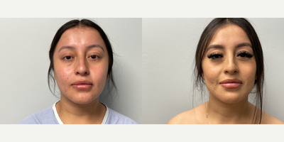 Liposuction before and after photo