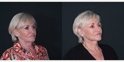 Neck Lift before and after photo