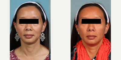 Chemical Peel before and after photo