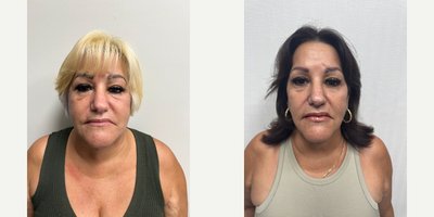 Facelift before and after photo
