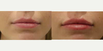Lip Fillers before and after photo