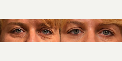 Restylane before and after photo