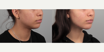 Chin Implant before and after photo