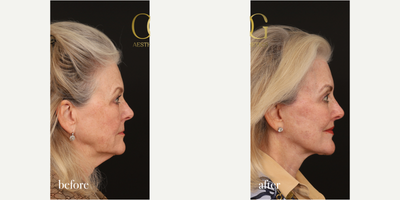 CO2 Laser before and after photo