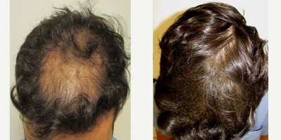 Hair Loss Treatment before and after photo