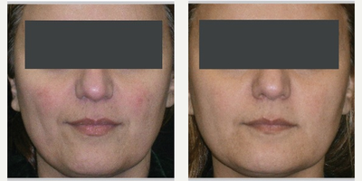 IPL before and after photo