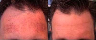 Laser Resurfacing before and after photo