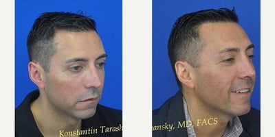 Rhinoplasty before and after photo