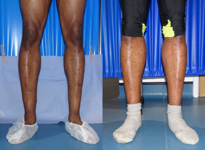 Calf Implant before and after photo