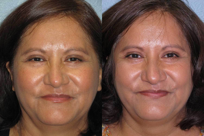 Eyelid Surgery before and after photo