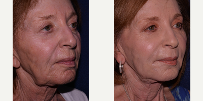 Facial Fat Transfer before and after photo