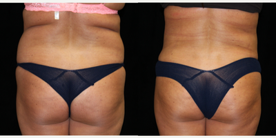 Liposuction before and after photo