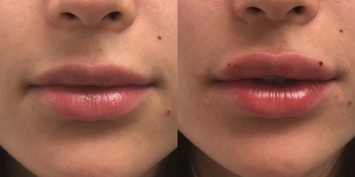 Restylane Silk before and after photo