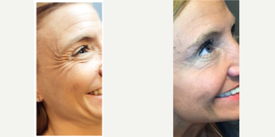 Botox before and after photo