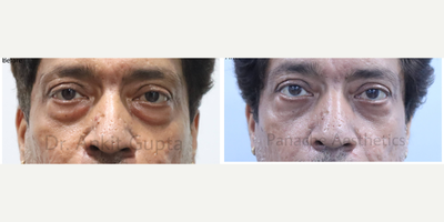 Eyelid Surgery before and after photo