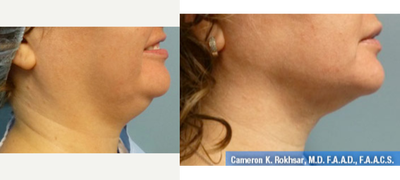 Liposuction before and after photo