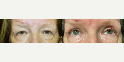 Skin Tightening before and after photo