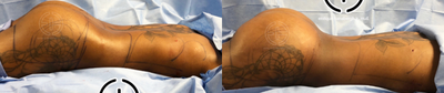 Brazilian Butt Lift before and after photo