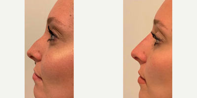 Dermal Fillers before and after photo