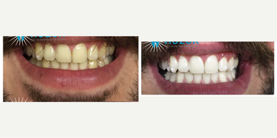 Teeth Whitening before and after photo