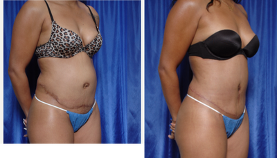 Tummy Tuck Revision before and after photo