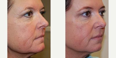 Botox before and after photo