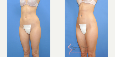 Brazilian Butt Lift before and after photo