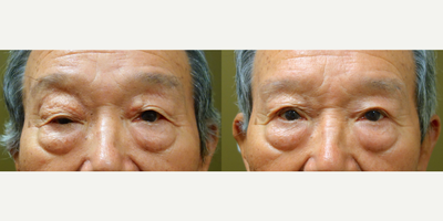 Double Eyelid Surgery before and after photo
