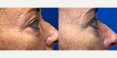 Eyelid Surgery before and after photo