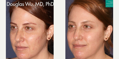 Fraxel Laser before and after photo