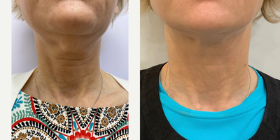 Radiesse before and after photo