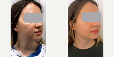 Vaser Liposuction before and after photo