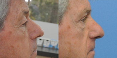 Eyelid Surgery before and after photo