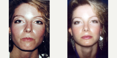 Rhinoplasty before and after photo