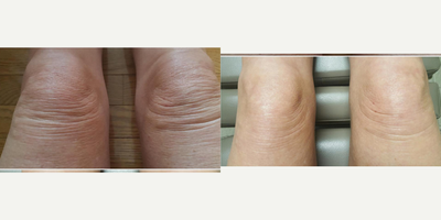 Contour Thread Lift before and after photo