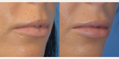 Lip Implants before and after photo
