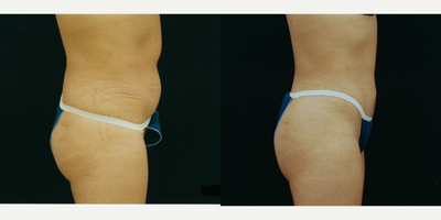 Liposuction before and after photo