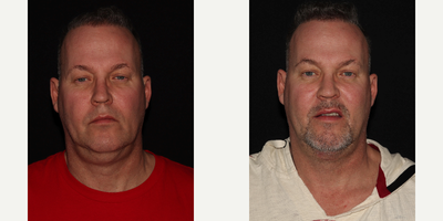 Neck Lift before and after photo