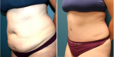 Tummy Tuck before and after photo