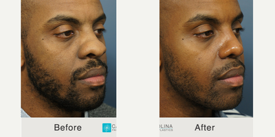 African American Rhinoplasty before and after photo