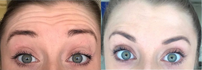 Botox before and after photo