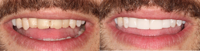 Dental Crown before and after photo