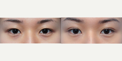 Double Eyelid Surgery before and after photo
