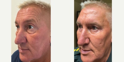 Eyelid Surgery before and after photo