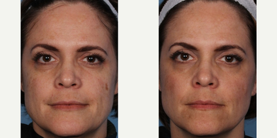 Fraxel Laser before and after photo
