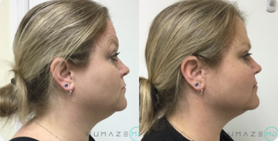 PrecisionTx before and after photo