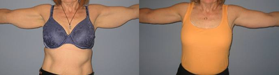 Arm Lift before and after photo